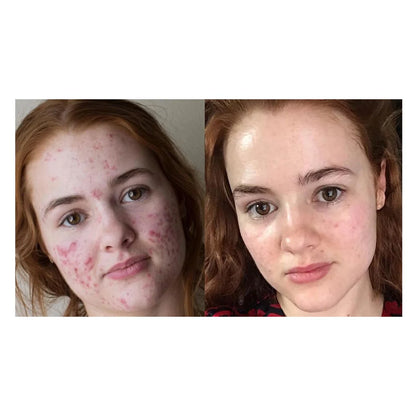 Hydrocolloid Roll for Skin Care